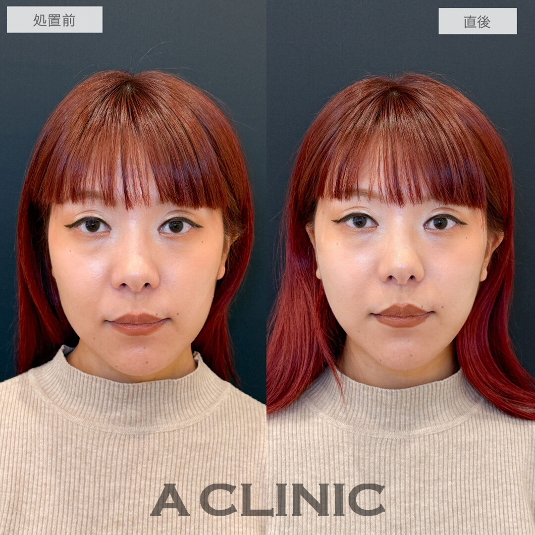 Aスレッドで左右差が改善され即日理想の輪郭に！処置前と直後の症例です(30代女性)