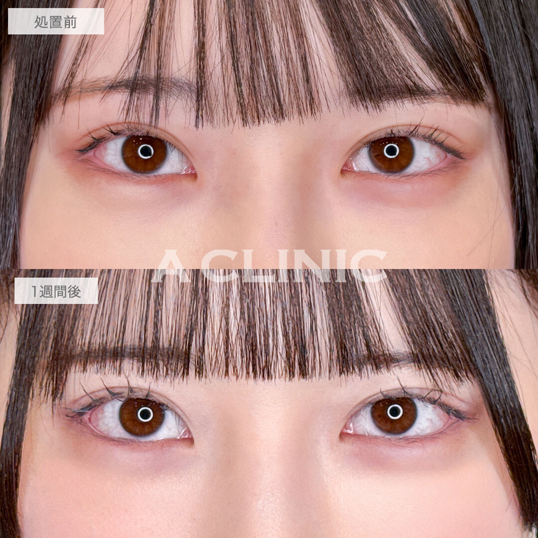 パーフェクトアイズで左右差と面長な印象が改善されました！処置前と1週間後の症例です(20代女性)