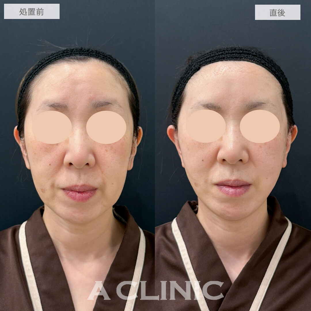 A式美肌たるみ切開でブルドッグ顔から綺麗なV字の輪郭に！処置前と直後の症例です(50代女性)