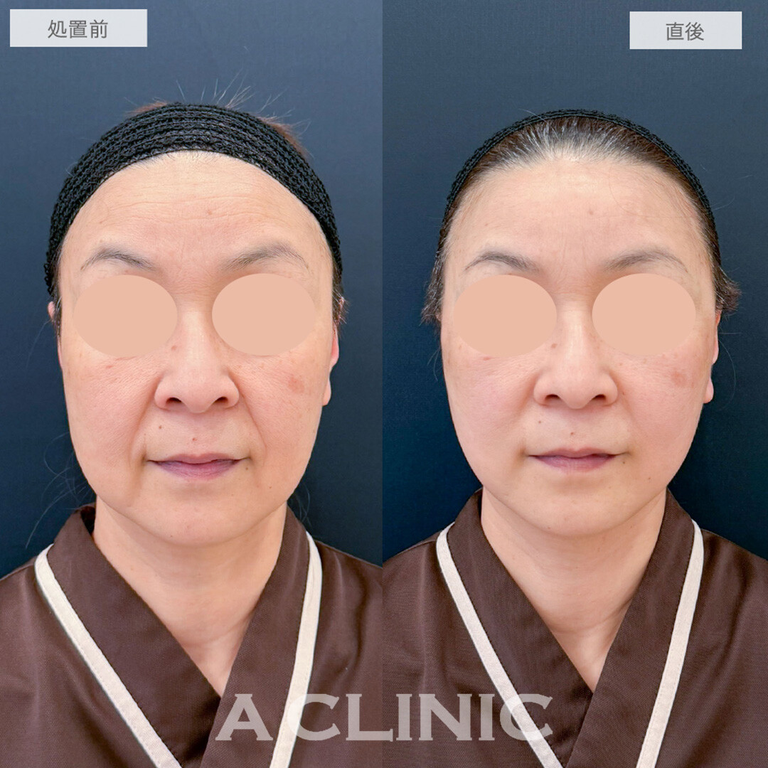 A式美肌たるみ切開で直後からほうれい線がなくなりたるみのない若々しいお顔に！処置前と直後の症例です(50代女性)