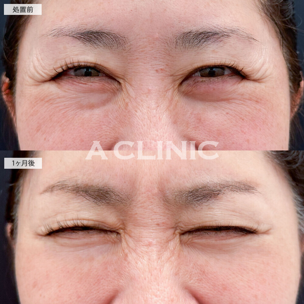 ボトックス注射(しわ)で老け顔の原因となる額と目元のシワ改善！こちら処置前と1ヶ月後の症例です(40代女性)