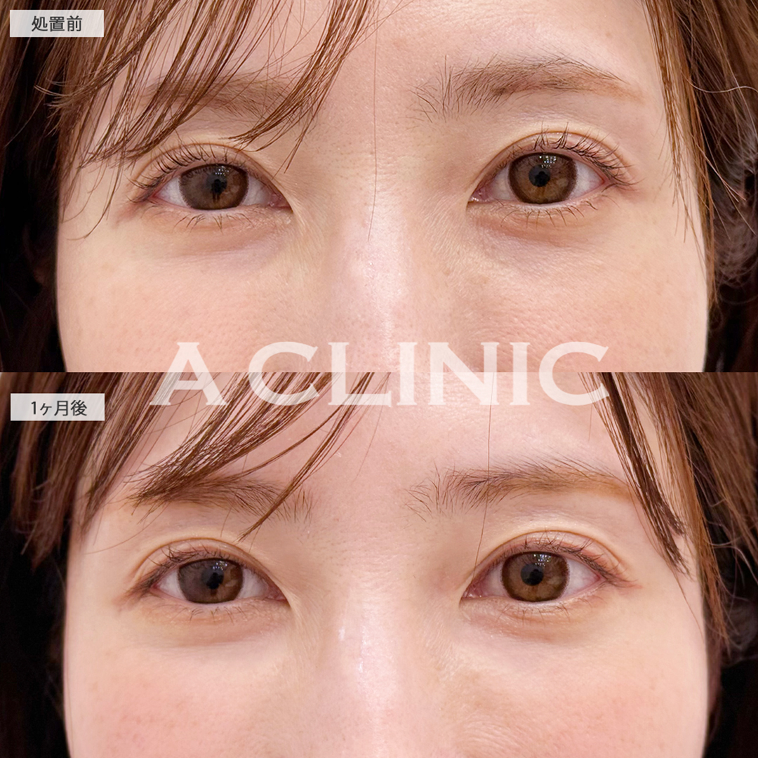 目の下のクマ取りで涙袋が誕生し疲れ目解消します！こちら処置前と1ヶ月後の症例です(30代女性)