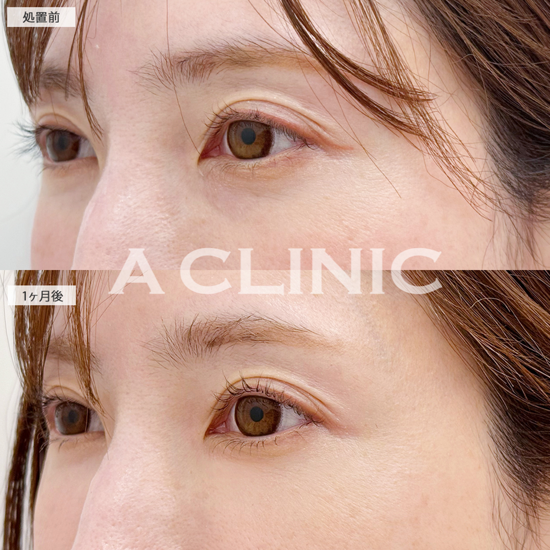 目の下のクマ取りで涙袋が誕生し疲れ目解消します！こちら処置前と1ヶ月後の症例です(30代女性)