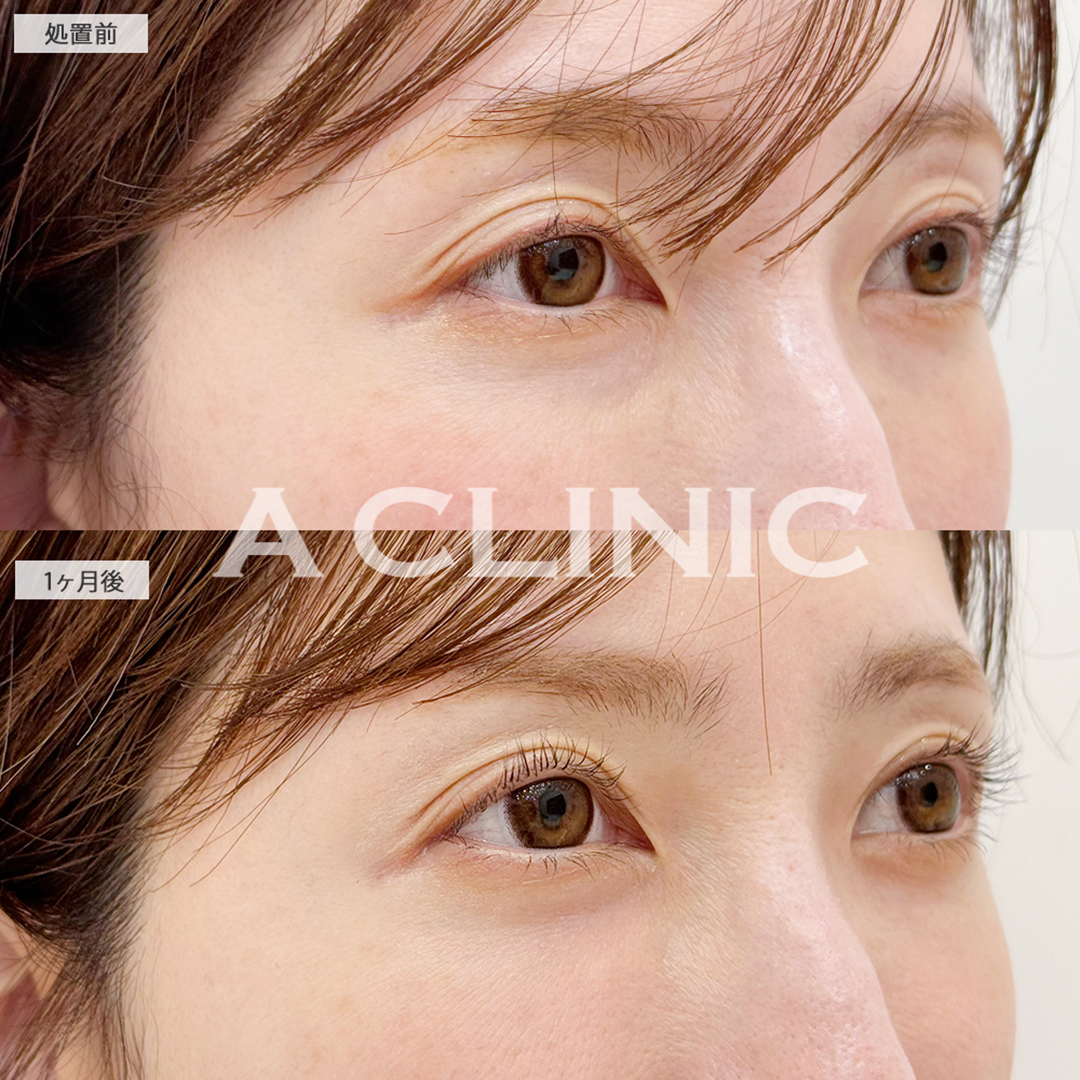 目の下のクマ取りで涙袋が誕生し疲れ目解消します！こちら処置前と1ヶ月後の症例です(30代女性)