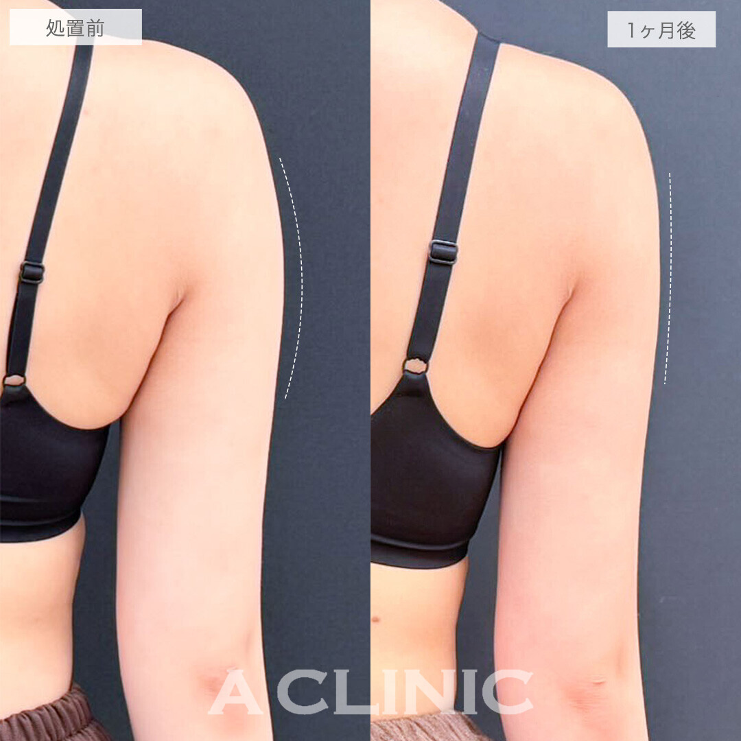 二の腕スリム脂肪吸引なら後ろ姿も華奢見えします！処置前と1ヶ月後の症例です(20代女性)
