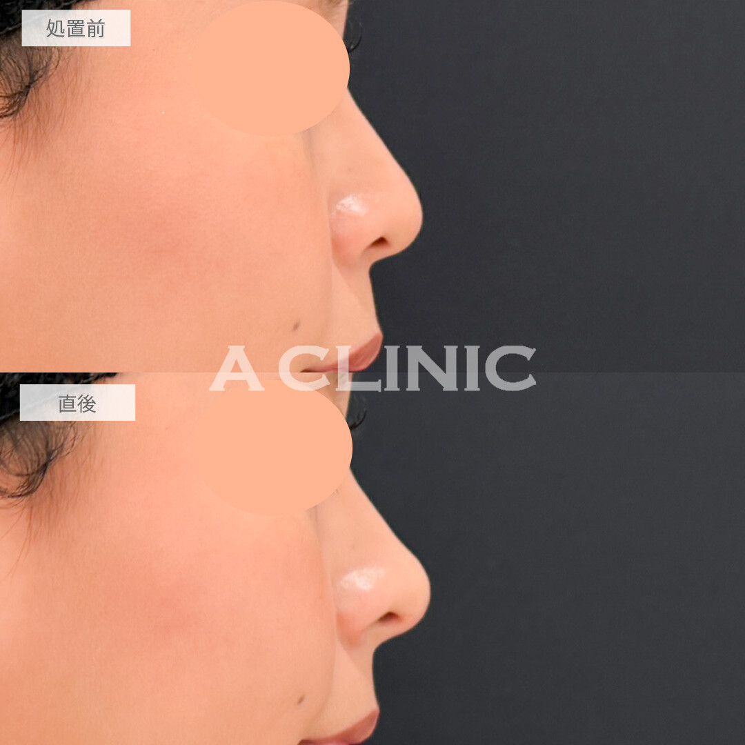 鼻ヒアルロン酸とあごへのヒアルロン酸注入でEライン形成と人中短縮が両方叶いました！処置前と直後の症例です(20代女性)
