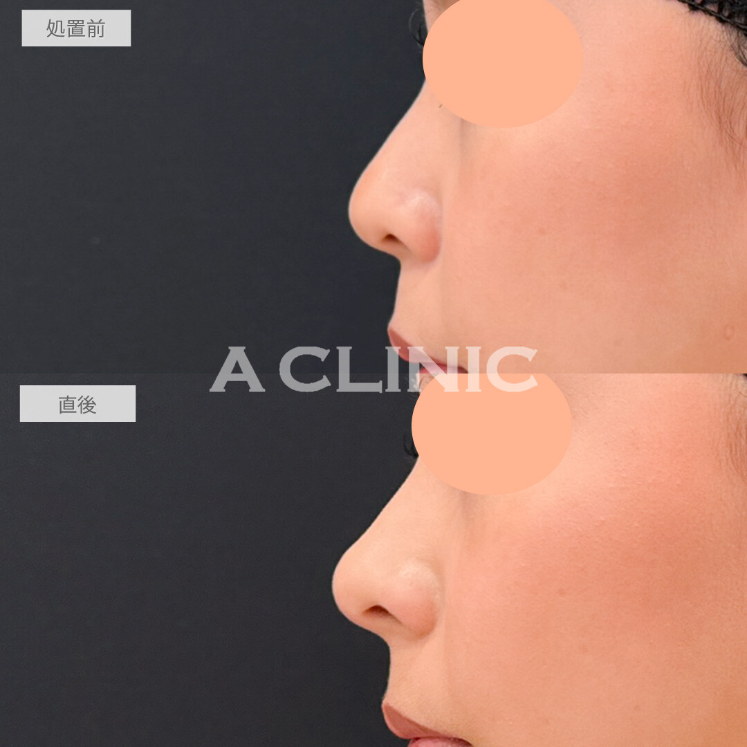 鼻ヒアルロン酸とあごへのヒアルロン酸注入でEライン形成と人中短縮が両方叶いました！処置前と直後の症例です(20代女性)