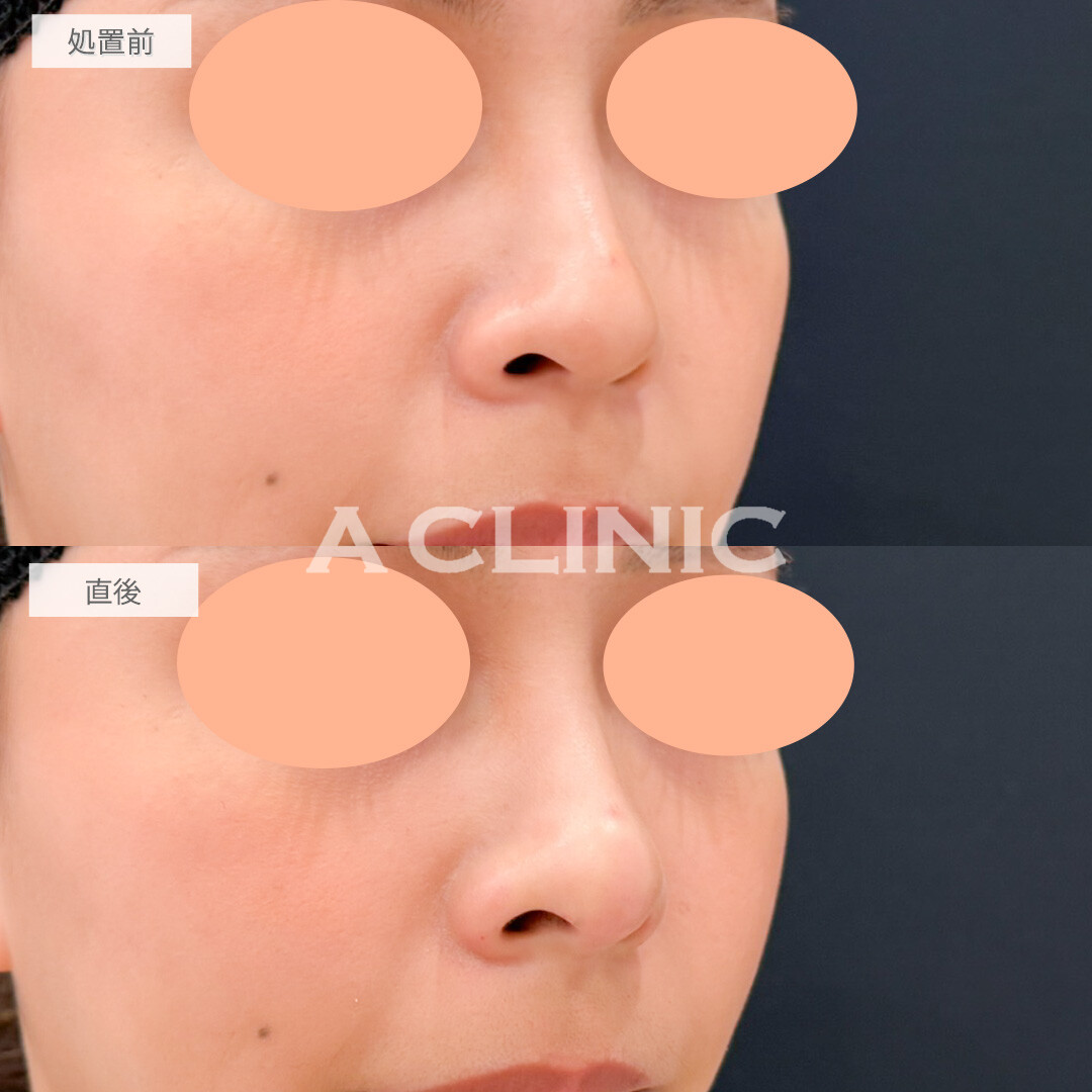 鼻ヒアルロン酸とあごへのヒアルロン酸注入でEライン形成と人中短縮が両方叶いました！処置前と直後の症例です(20代女性)