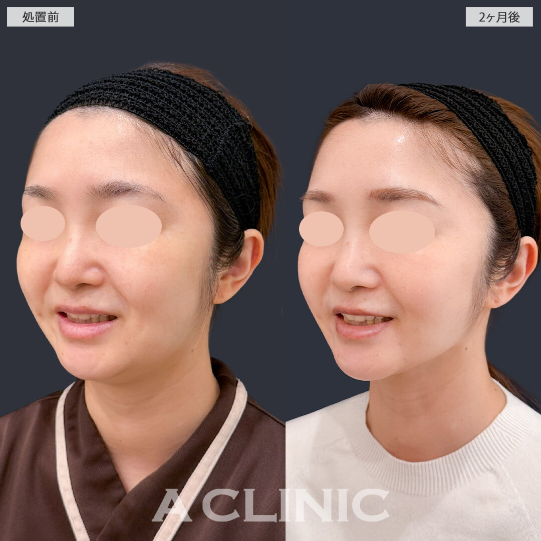 1day小顔脂肪吸引とバッカルファット除去術で輪郭がすっきりして理想の小顔になれました！こちら処置前と2か月後の症例です(30代女性)