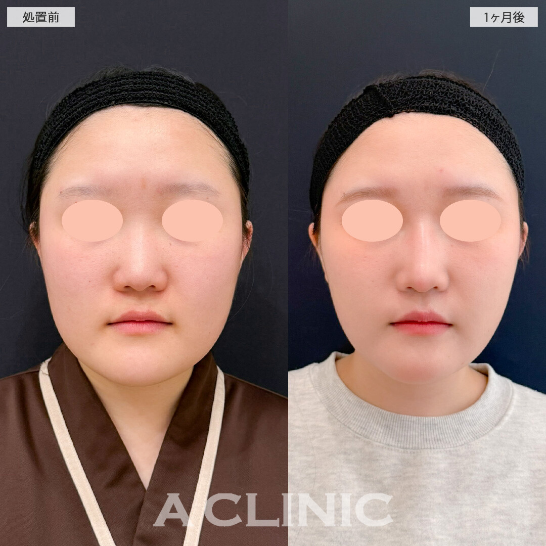 1day小顔脂肪吸引でフェイスラインからあご下までしっかり脂肪を除去できます！こちら処置前と1か月後の症例です(20代女性)