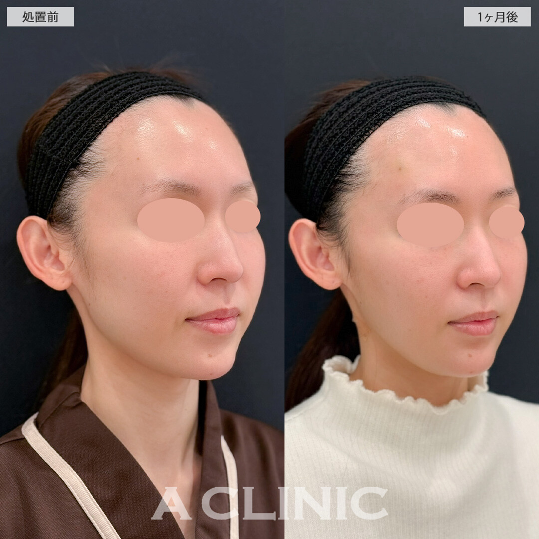 1day小顔脂肪吸引と小顔エラボトックスでひょうたん型からきれいな卵型の輪郭に！こちら処置前と1か月後の症例です(30代女性)
