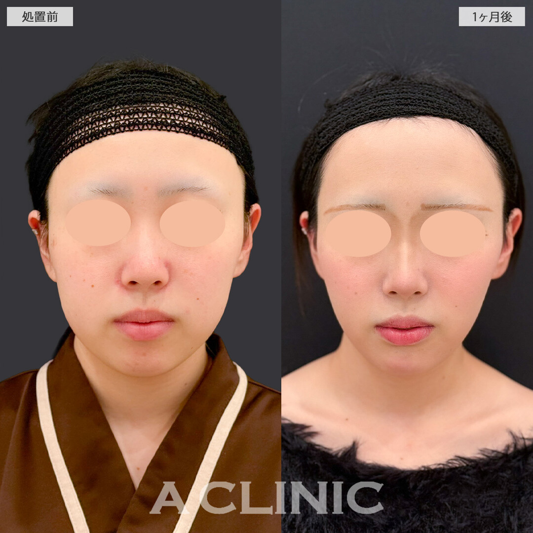 1day小顔脂肪吸引とバッカルファット除去術で気になる脂肪を一掃して垢抜け加速しました！こちら処置前と1か月後の症例です(20代女性)