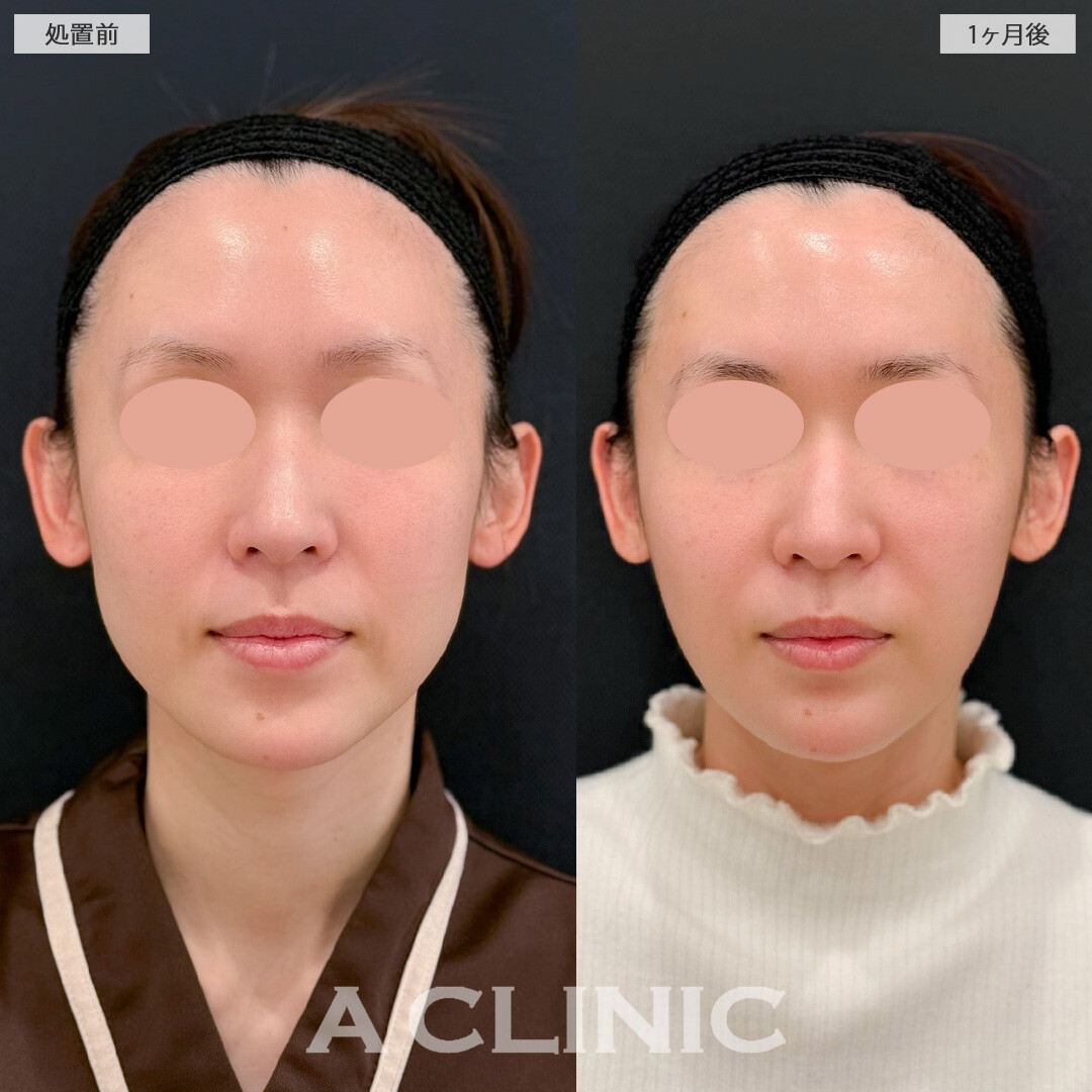 1day小顔脂肪吸引と小顔エラボトックスでひょうたん型からきれいな卵型の輪郭に！こちら処置前と1か月後の症例です(30代女性)