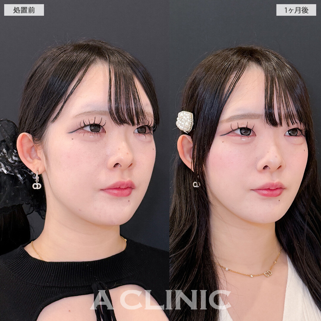 1day小顔脂肪吸引で余白がなくなって他撮りがさらに盛れるようになります！こちら処置前と1か月後の症例です(20代女性)