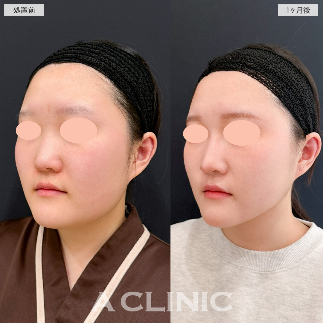 1day小顔脂肪吸引でフェイスラインからあご下までしっかり脂肪を除去できます！こちら処置前と1か月後の症例です(20代女性)