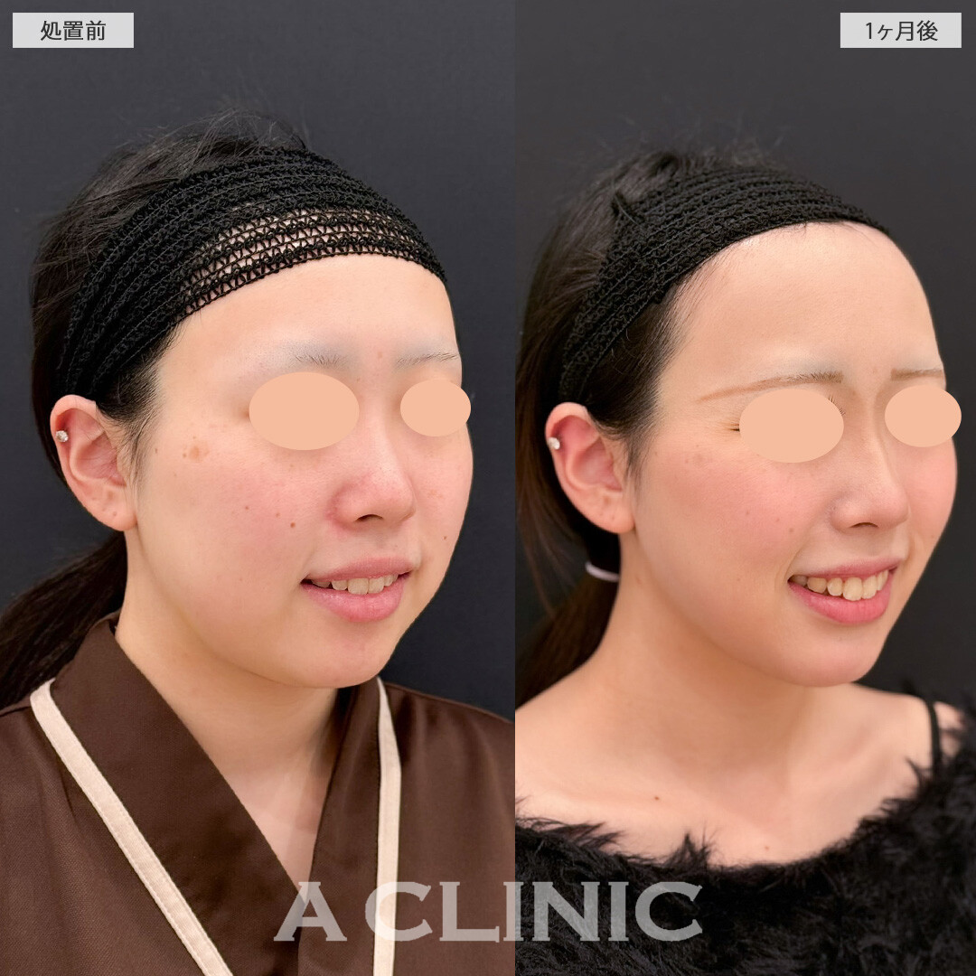 1day小顔脂肪吸引とバッカルファット除去術で気になる脂肪を一掃して垢抜け加速しました！こちら処置前と1か月後の症例です(20代女性)