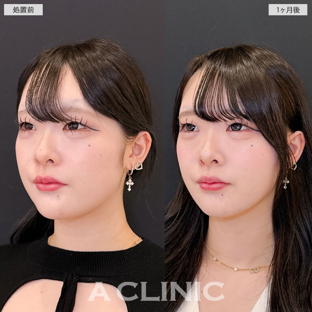 1day小顔脂肪吸引で余白がなくなって他撮りがさらに盛れるようになります！こちら処置前と1か月後の症例です(20代女性)