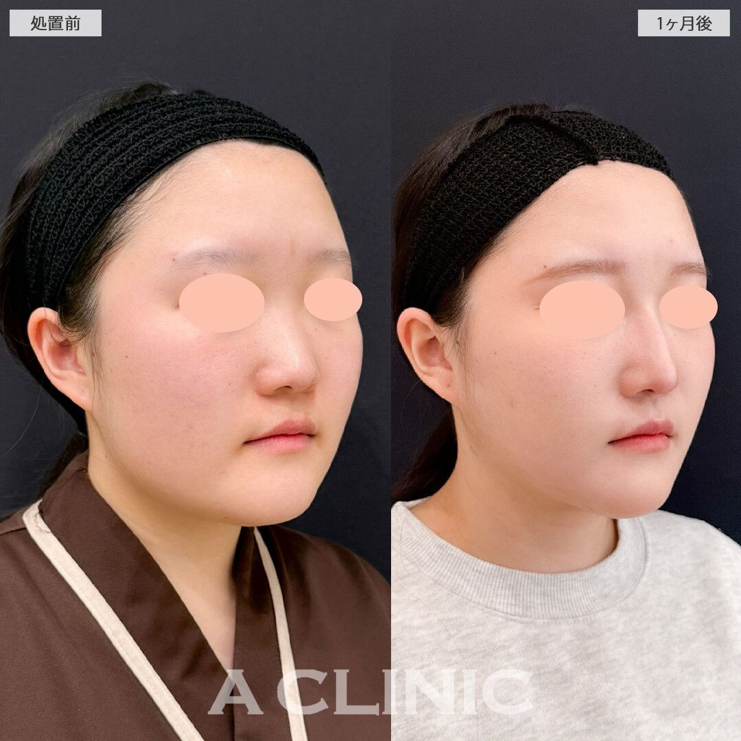 1day小顔脂肪吸引でフェイスラインからあご下までしっかり脂肪を除去できます！こちら処置前と1か月後の症例です(20代女性)