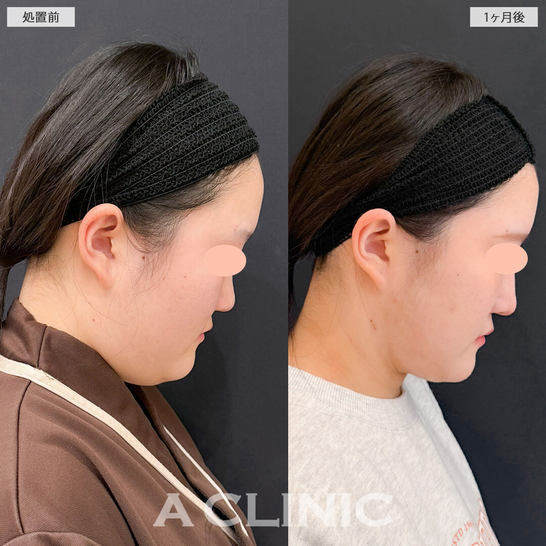 1day小顔脂肪吸引でフェイスラインからあご下までしっかり脂肪を除去できます！こちら処置前と1か月後の症例です(20代女性)