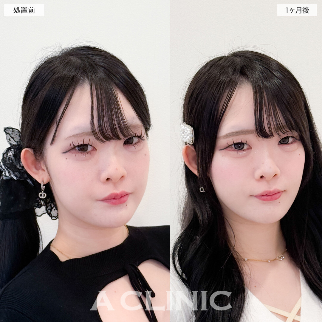 1day小顔脂肪吸引で余白がなくなって他撮りがさらに盛れるようになります！こちら処置前と1か月後の症例です(20代女性)