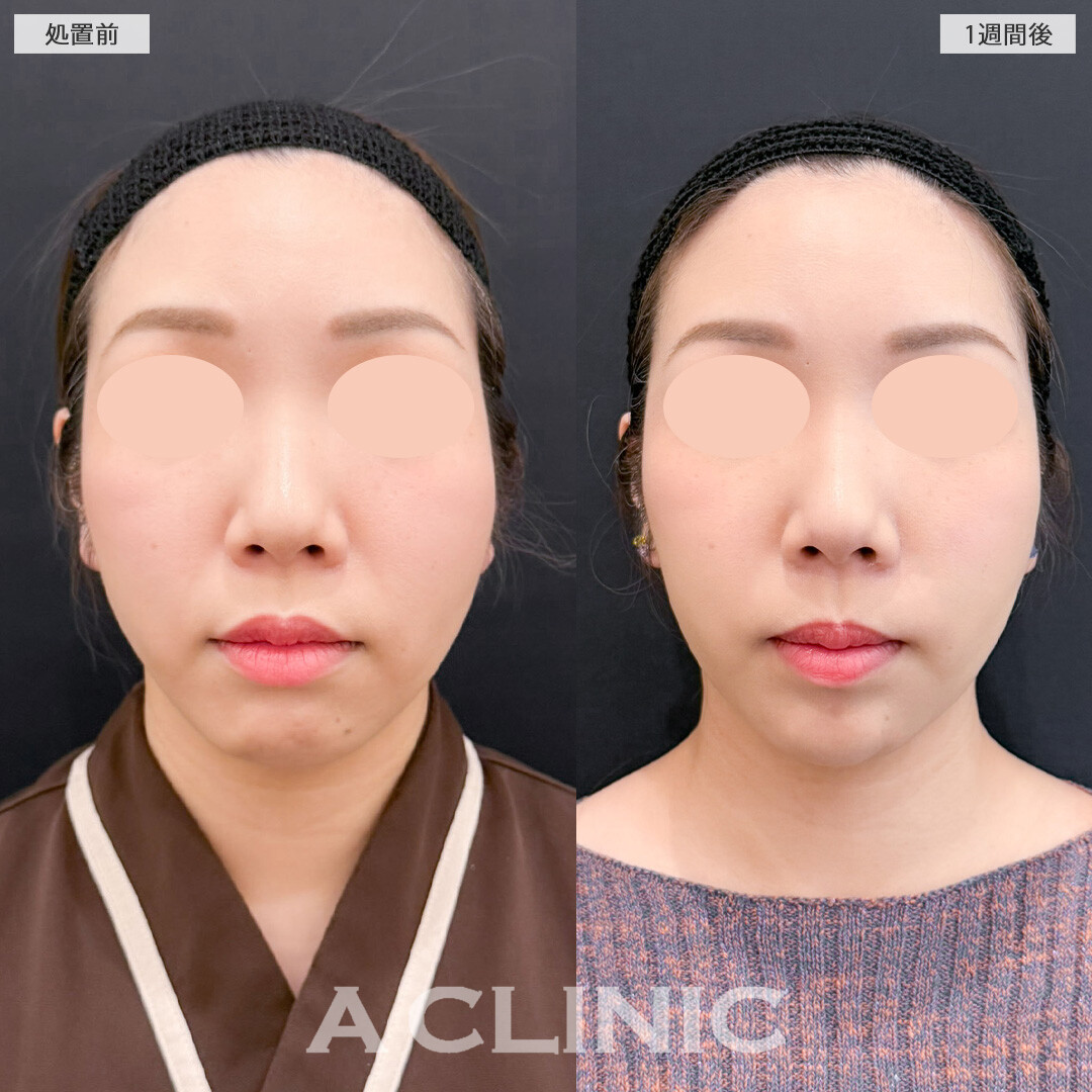 1day小顔脂肪吸引でお顔下半分のもたつきをなくすことで若返り成功！こちら処置前と1週間後の症例です(30代女性)