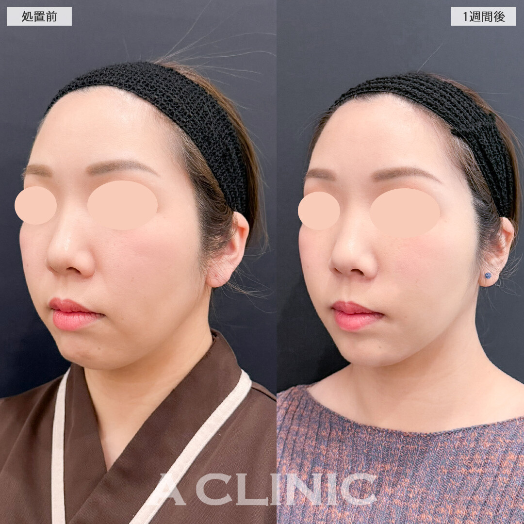 1day小顔脂肪吸引でお顔下半分のもたつきをなくすことで若返り成功！こちら処置前と1週間後の症例です(30代女性)