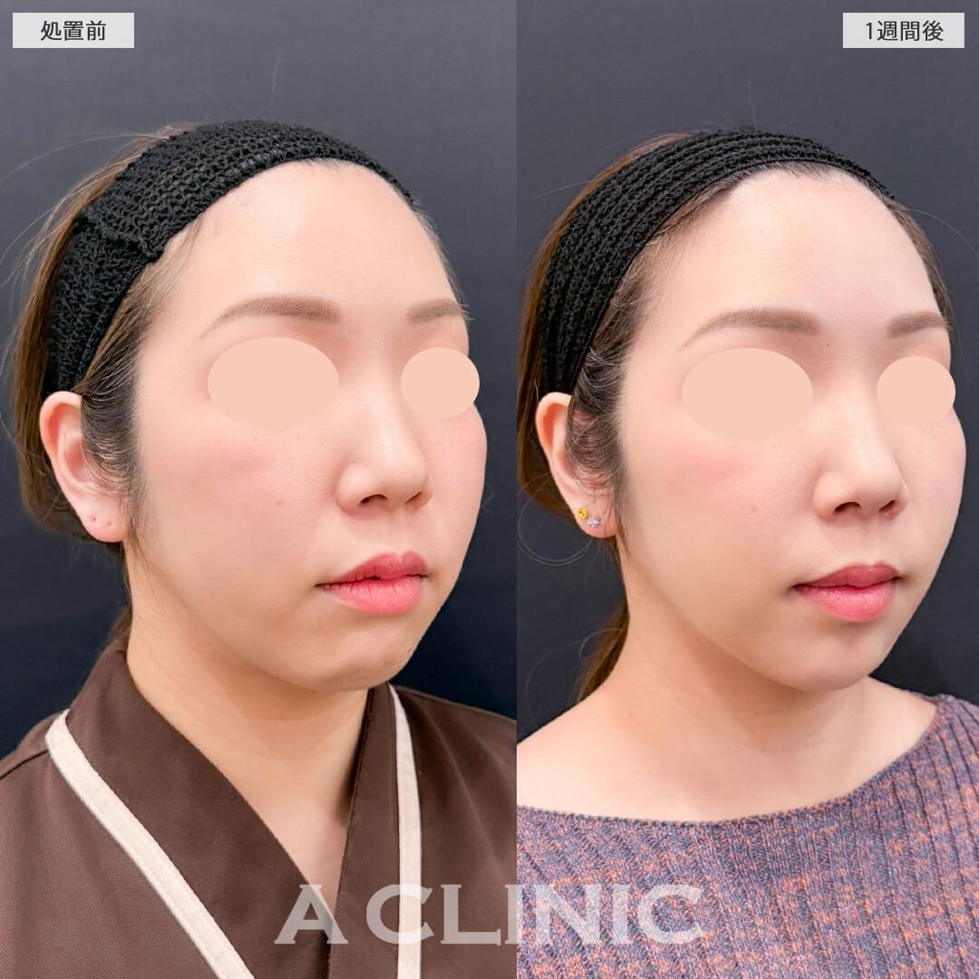 1day小顔脂肪吸引でお顔下半分のもたつきをなくすことで若返り成功！こちら処置前と1週間後の症例です(30代女性)