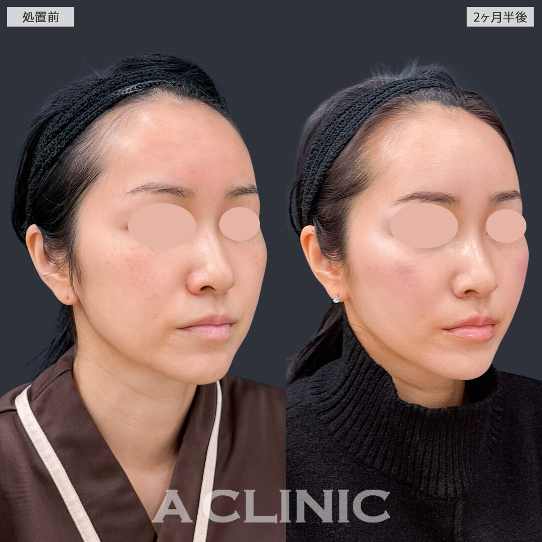 1day小顔脂肪吸引でナチュラルなVフェイスになれました！こちら処置前と2か月半後の症例です(40代女性)