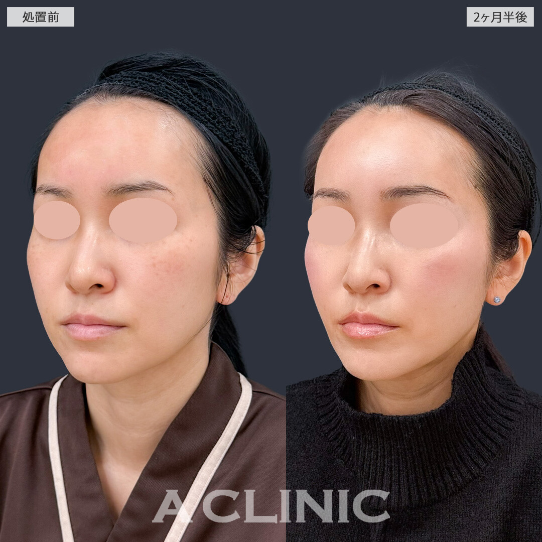 1day小顔脂肪吸引でナチュラルなVフェイスになれました！こちら処置前と2か月半後の症例です(40代女性)