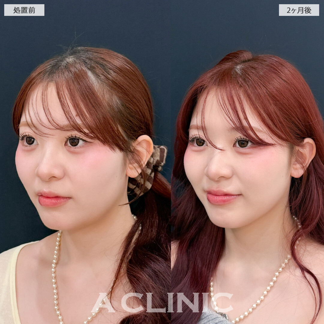 1day小顔脂肪吸引でナチュラルだけど確実に小顔になれます！こちら処置前と2か月後の症例です(20代女性)