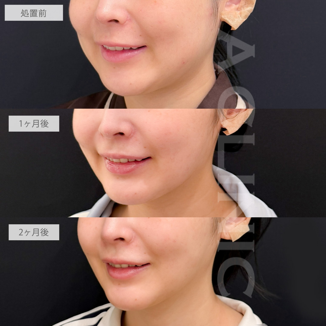 1day小顔脂肪吸引とバッカルファット除去術で欠点のない小顔に大変身！こちら処置前から2ヶ月後の症例です(20代女性)