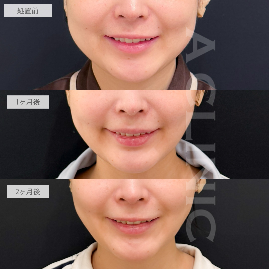 1day小顔脂肪吸引とバッカルファット除去術で欠点のない小顔に大変身！こちら処置前から2ヶ月後の症例です(20代女性)
