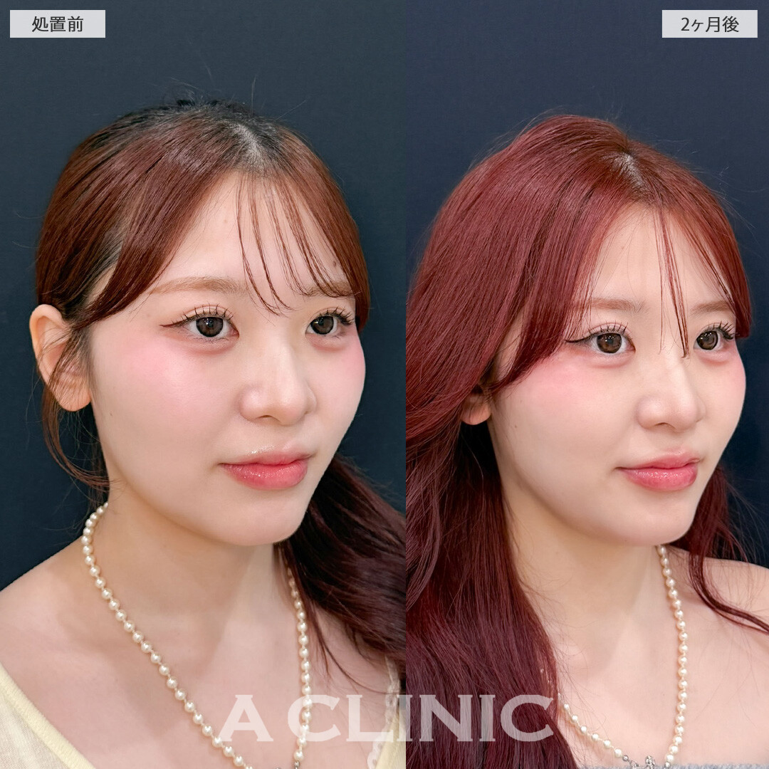 1day小顔脂肪吸引でナチュラルだけど確実に小顔になれます！こちら処置前と2か月後の症例です(20代女性)