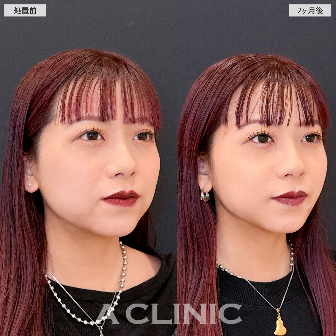 1day小顔脂肪吸引で脂肪のもたつきを減らして垢抜け小顔に！こちら処置前と2ヶ月後の症例です(20代女性)
