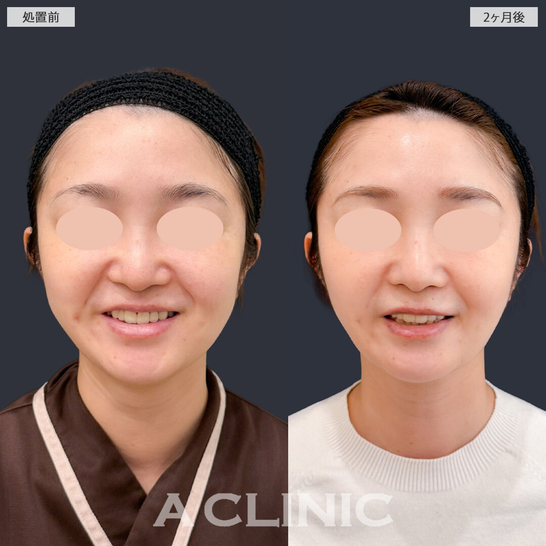 1day小顔脂肪吸引とバッカルファット除去術で輪郭がすっきりして理想の小顔になれました！こちら処置前と2か月後の症例です(30代女性)