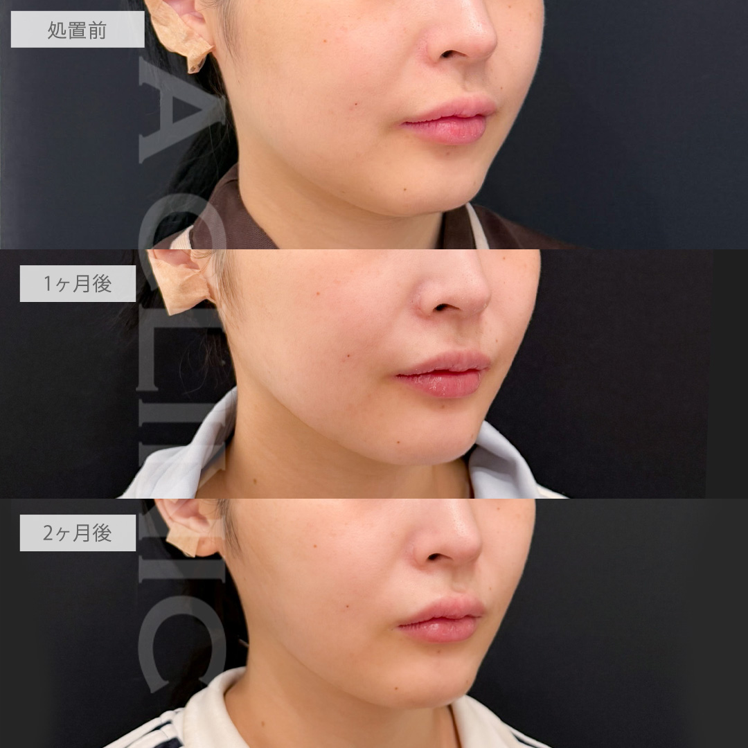 1day小顔脂肪吸引とバッカルファット除去術で欠点のない小顔に大変身！こちら処置前から2ヶ月後の症例です(20代女性)