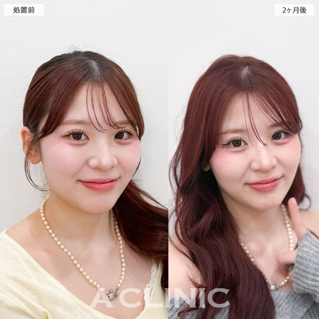 1day小顔脂肪吸引でナチュラルだけど確実に小顔になれます！こちら処置前と2か月後の症例です(20代女性)