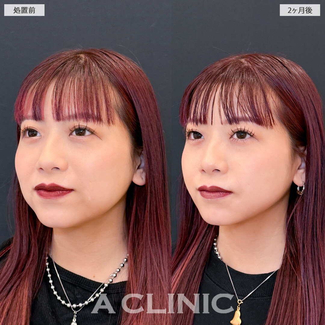 1day小顔脂肪吸引で脂肪のもたつきを減らして垢抜け小顔に！こちら処置前と2ヶ月後の症例です(20代女性)