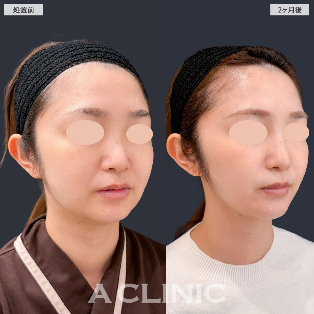1day小顔脂肪吸引とバッカルファット除去術で輪郭がすっきりして理想の小顔になれました！こちら処置前と2か月後の症例です(30代女性)