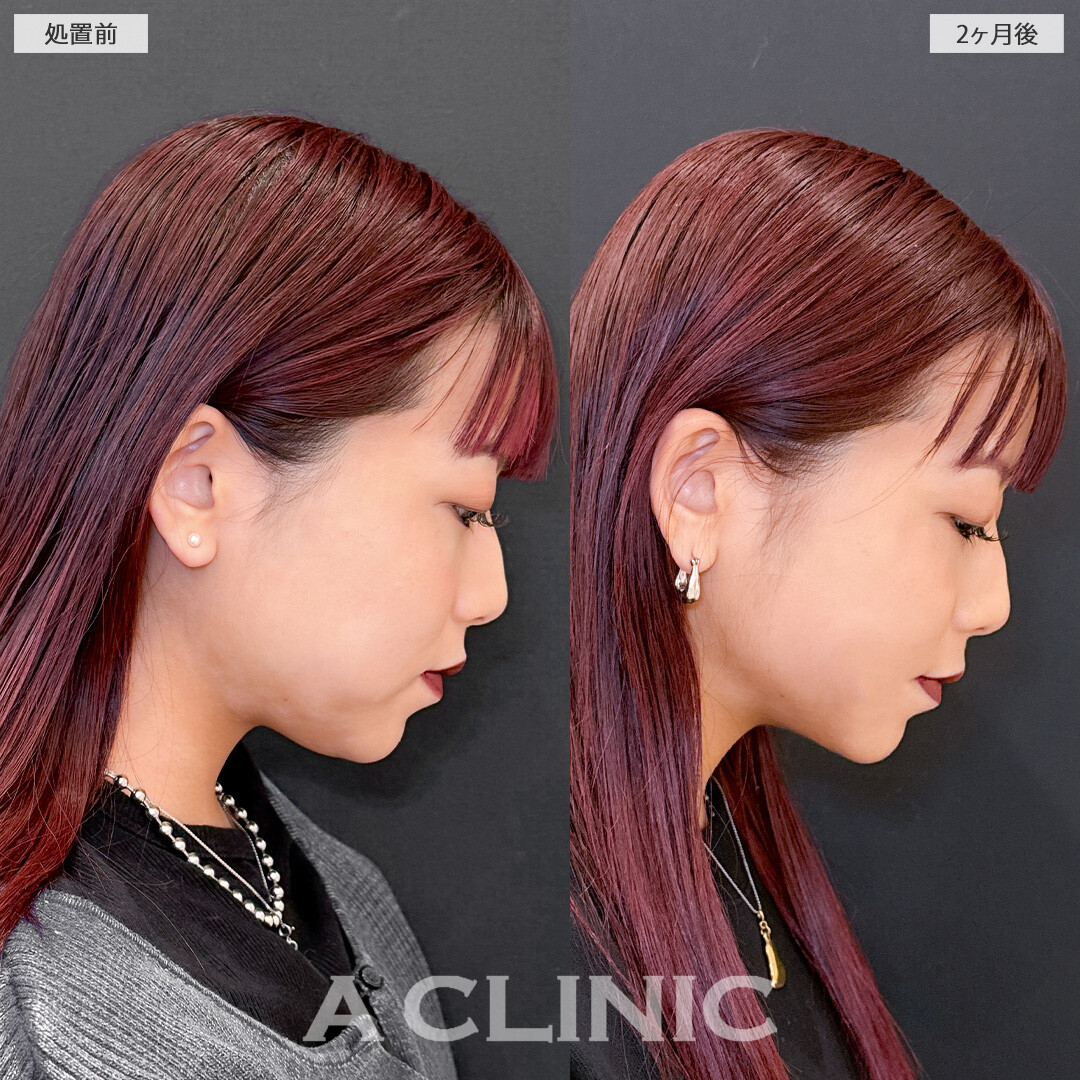 1day小顔脂肪吸引で脂肪のもたつきを減らして垢抜け小顔に！こちら処置前と2ヶ月後の症例です(20代女性)