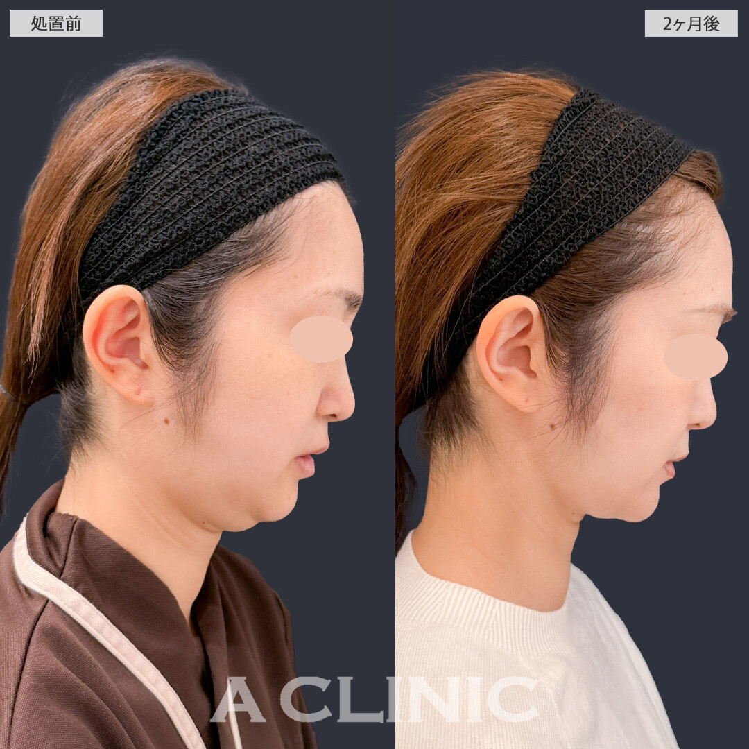 1day小顔脂肪吸引とバッカルファット除去術で輪郭がすっきりして理想の小顔になれました！こちら処置前と2か月後の症例です(30代女性)