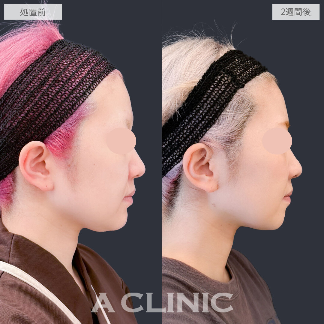 1day小顔脂肪吸引であご下の脂肪を撃退して無駄のないフェイスラインに！こちら処置前と2週間後の症例です(30代女性)