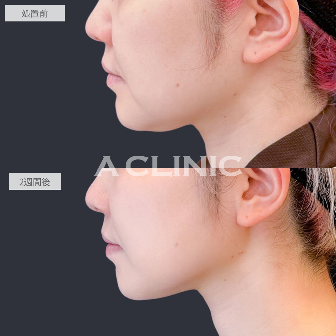 1day小顔脂肪吸引であご下の脂肪を撃退して無駄のないフェイスラインに！こちら処置前と2週間後の症例です(30代女性)