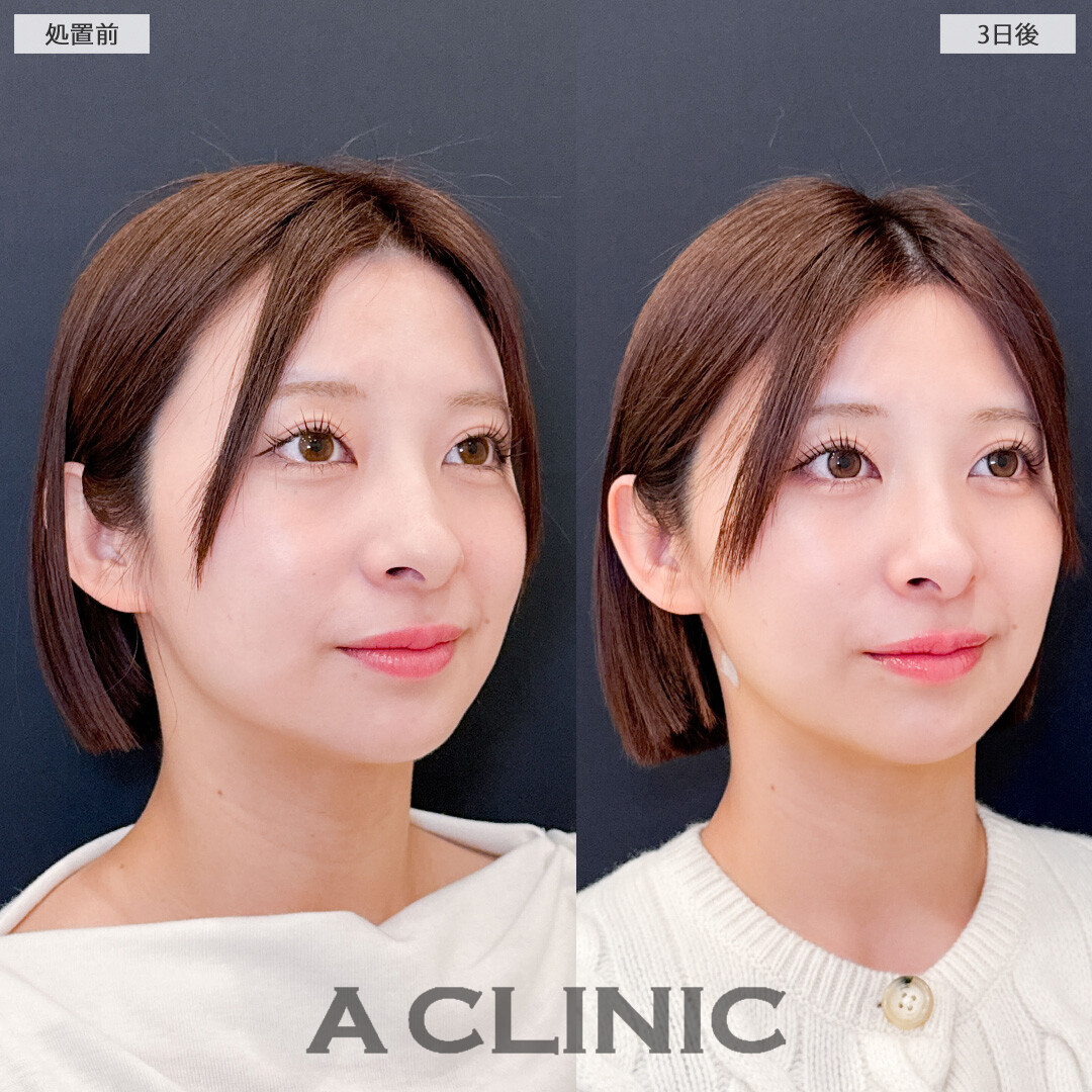 1day小顔脂肪吸引で腫れが少なく自然に小顔になりました！こちら処置前と3日後の症例です(20代女性)