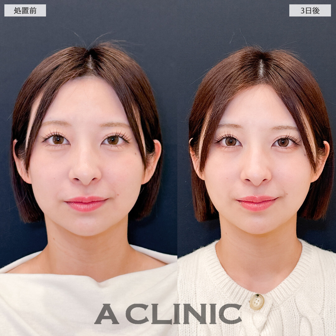 1day小顔脂肪吸引で腫れが少なく自然に小顔になりました！こちら処置前と3日後の症例です(20代女性)