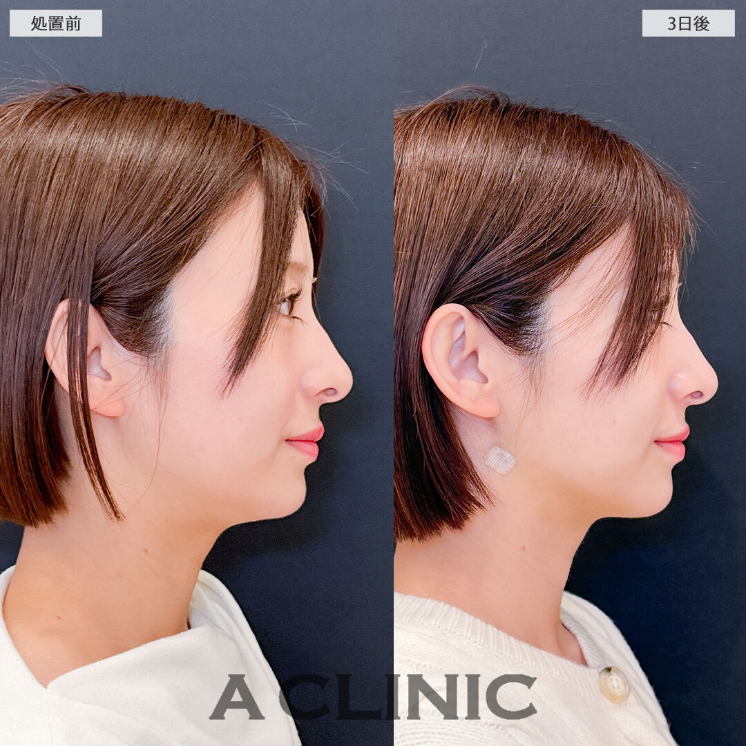 1day小顔脂肪吸引で腫れが少なく自然に小顔になりました！こちら処置前と3日後の症例です(20代女性)