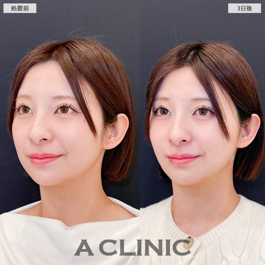 1day小顔脂肪吸引で腫れが少なく自然に小顔になりました！こちら処置前と3日後の症例です(20代女性)