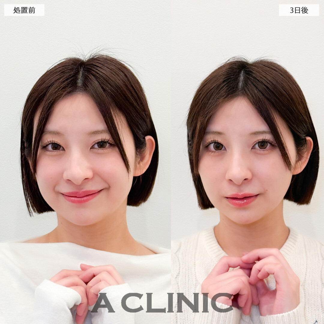 1day小顔脂肪吸引で腫れが少なく自然に小顔になりました！こちら処置前と3日後の症例です(20代女性)