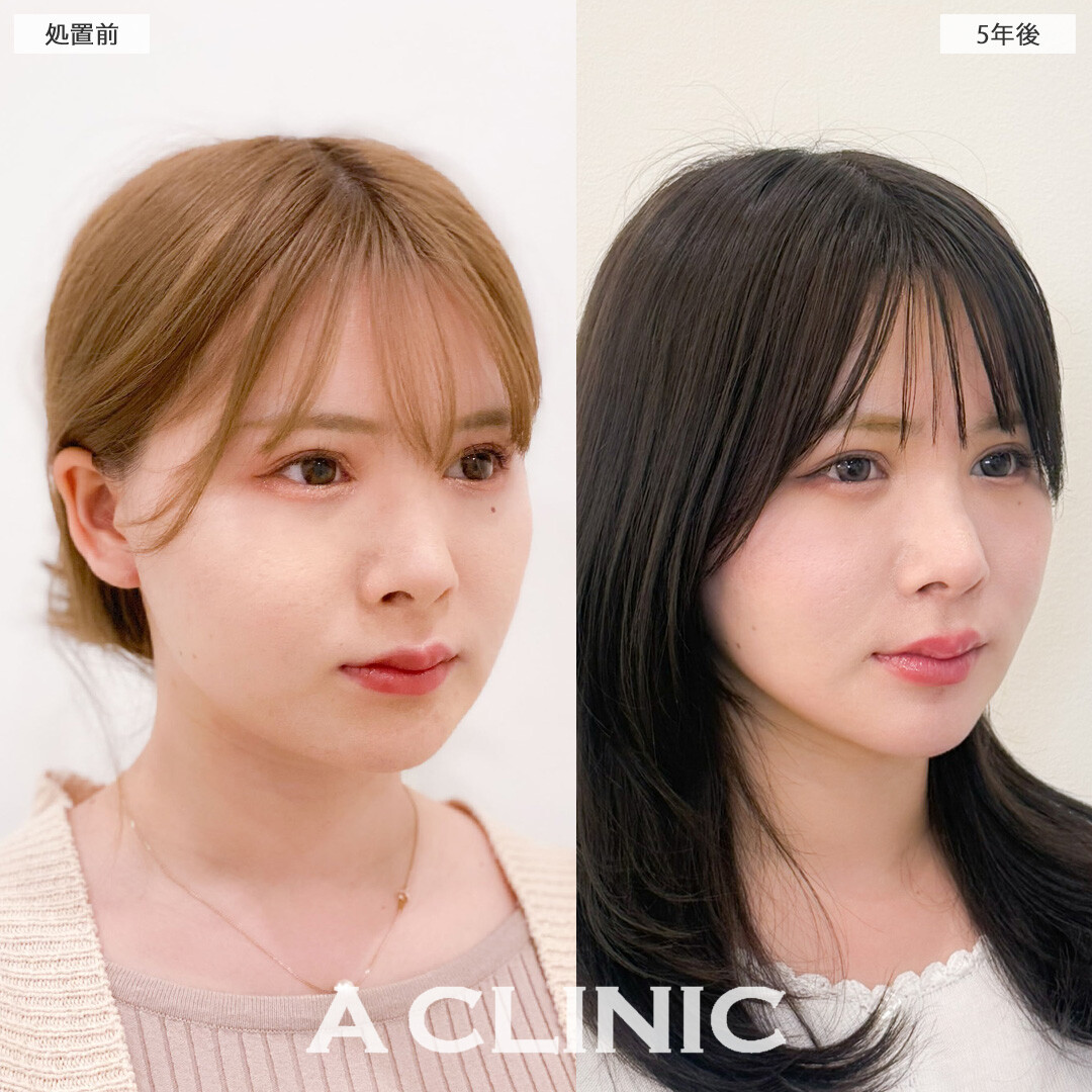 1day小顔脂肪吸引は理想の小顔を1回の施術で手に入れられます！こちら処置前と5年後の症例です(30代女性)