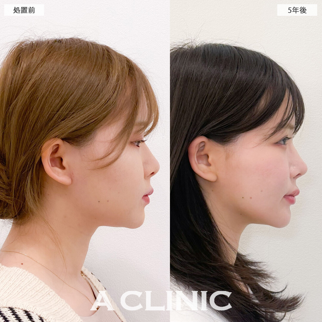 1day小顔脂肪吸引は理想の小顔を1回の施術で手に入れられます！こちら処置前と5年後の症例です(30代女性)